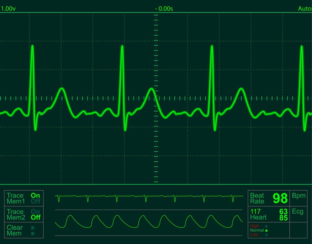 ECG and cardiovascular risk in HIV