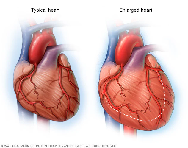 Heart failure risk in HIV